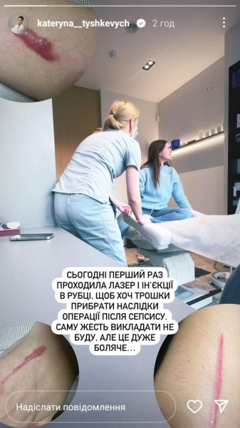 Тишкевич показала рубці після лікування сепсису