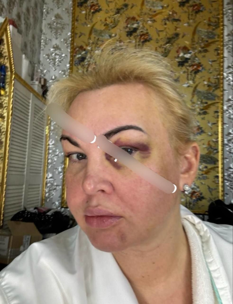 У Мережі з'явилися фото скривавленого обличчя Камалії: співачка відповіла на чутки про насильство