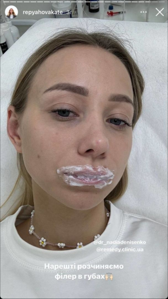 Дружина Віктора Павліка неочікувано зменшила губи і показала, який вигляд має